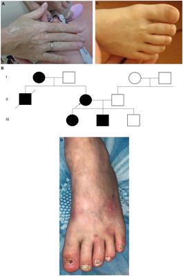 Syndromic epidermolysis bullosa simplex subtype due to mutations in the KLHL24 gene: series of case reports in Russian families